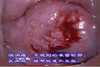 宫颈肥大糜烂怎么治疗