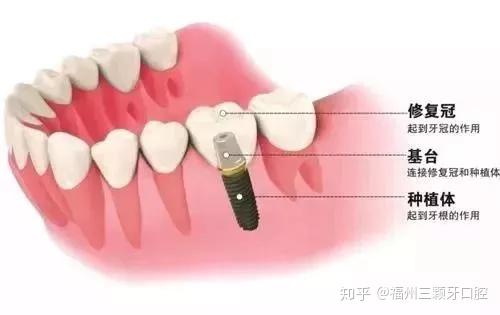 牙齿种植全过程