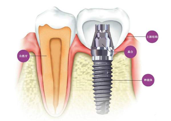种植牙一颗费用多少钱