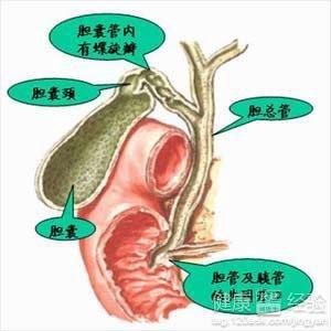 胆结石切除对身体有什么影响