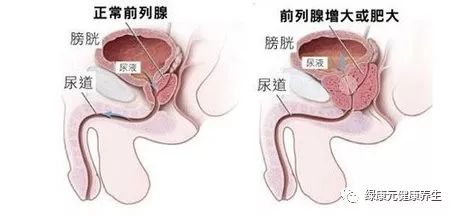 中医治疗前列腺肥大，最新解答方案与效果探讨，实践验证解释定义_安卓76.56.66