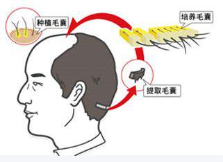 3000毛囊单位植发多少钱