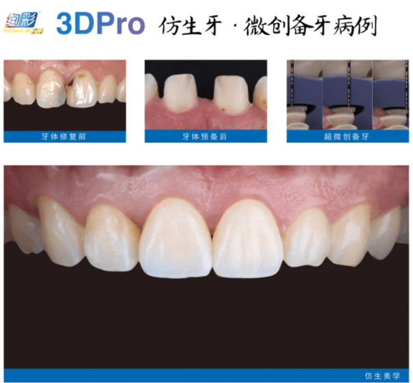 全瓷牙与烤瓷牙有什么区别